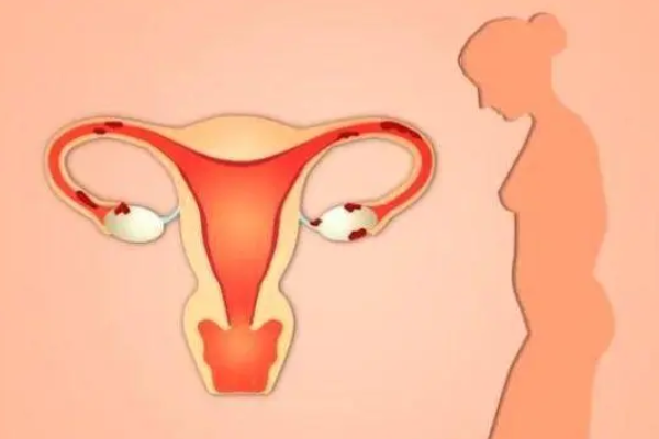 子宫畸形影响生育能力