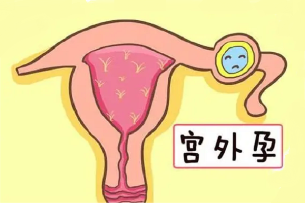 运动能预防宫外孕