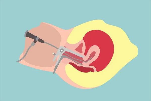 宫腔镜手术是妇科疾病治疗的重要手段