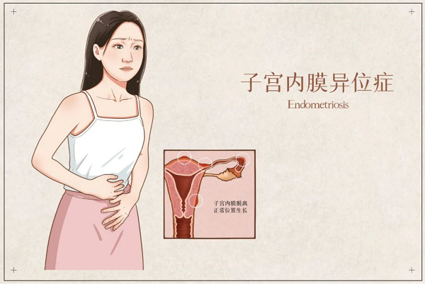 腹腔镜手术可治疗子宫内膜异位症