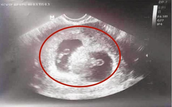有两个胎心可能是龙凤胎