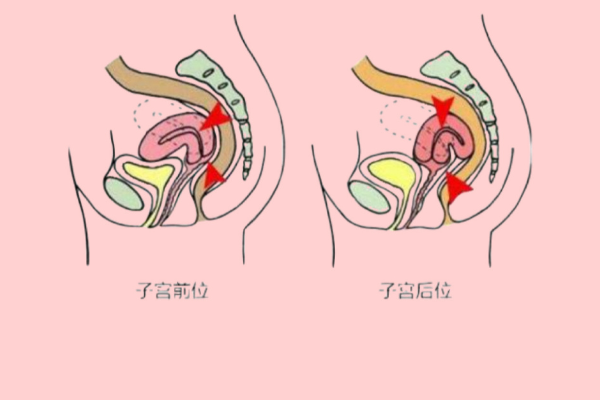 子宫前位是子宫向膀胱倾斜
