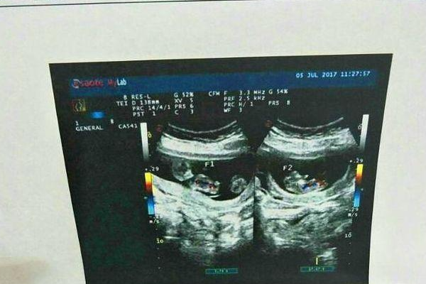 胎儿较小导致早期看不出双胎