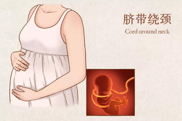脐带绕颈是孕期正常现象