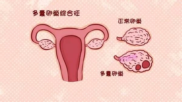 多囊会导致卵子发育慢