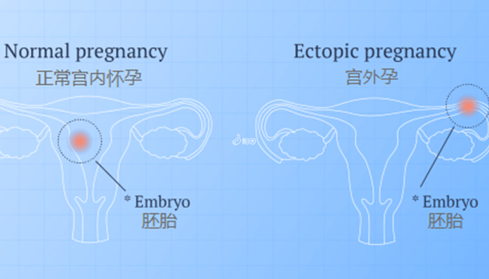 宫外孕比正常怀孕对比