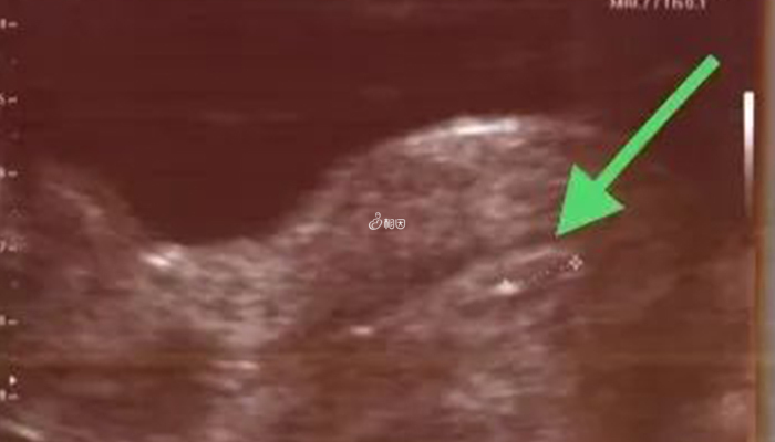 胚胎移植的位置