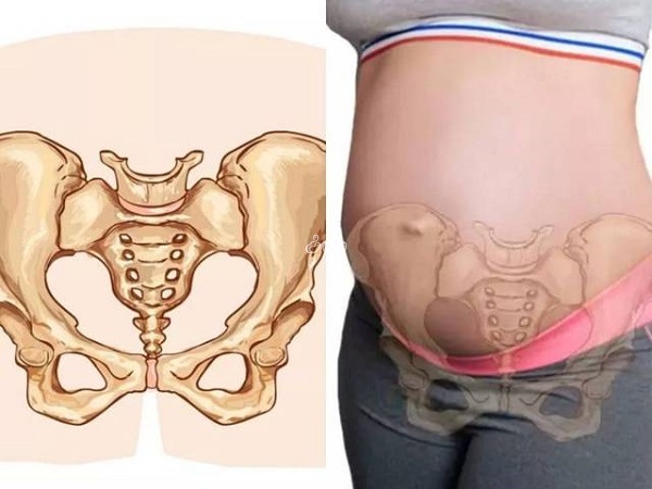 孕妇耻骨疼可能是由于耻骨联合分离