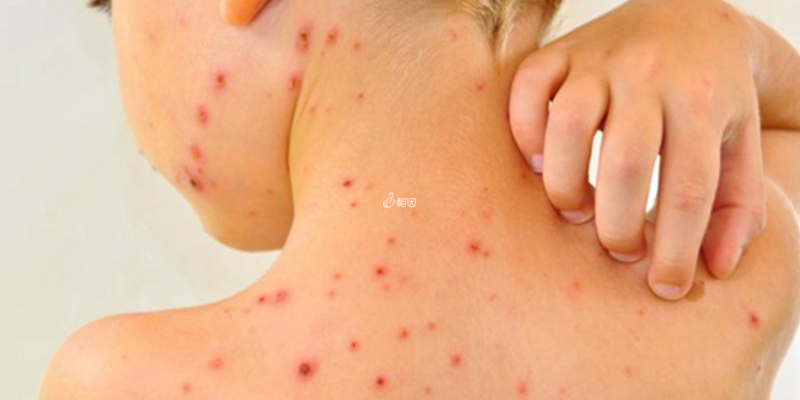 幼儿急疹10个征兆