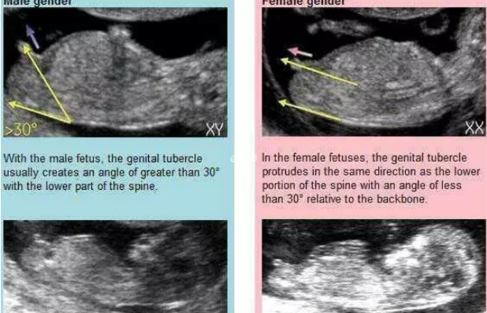 NT检查主要通过胎儿尾椎处的倾斜角度判断男女