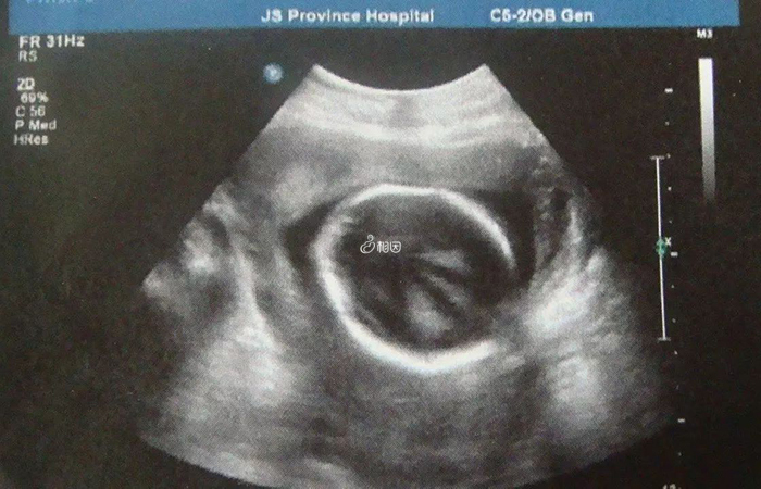 胎儿肾盂未见分离60%是出现在男孩身上