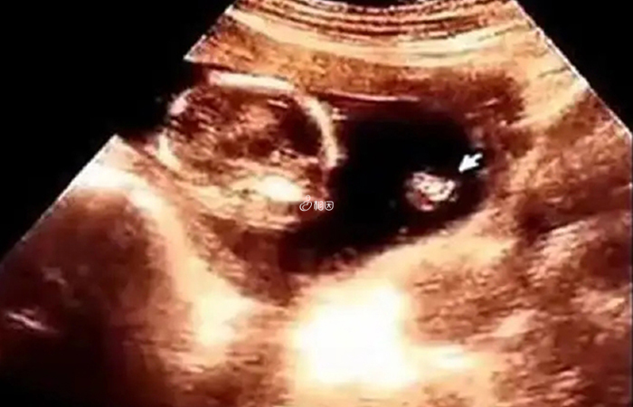 直接观察彩超图像可以判断出胎儿的性别