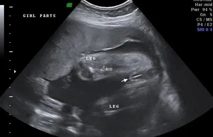 B超图像中胎儿两腿之间没有东西不一定是女孩