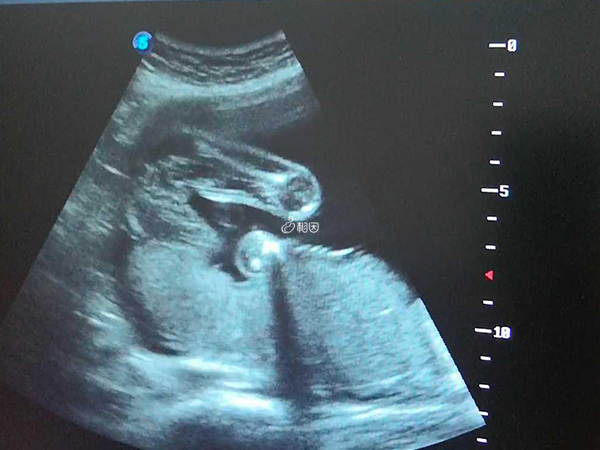 胎儿臀位是指胎儿在子宫内的姿势