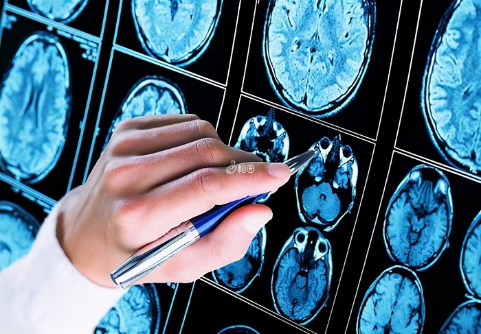 脑CT是一种检查脑部疾病的方法