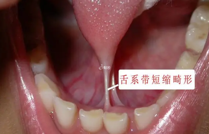 剪舌系带容易出现创口发炎