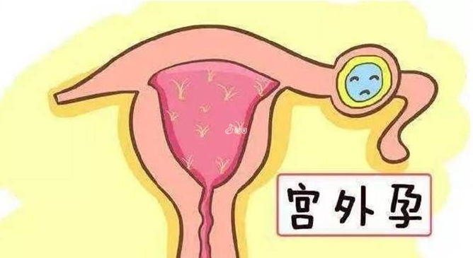 宫外孕会导致空孕囊出现