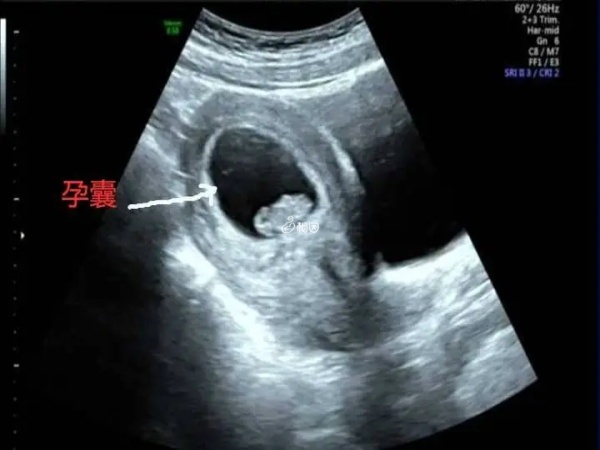 胎囊直径能判断怀孕的天数