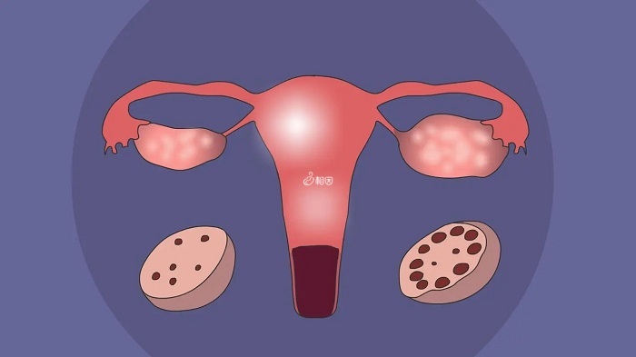多囊卵巢综合征是一种比较常见的妇科疾病