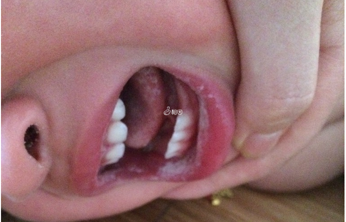 当婴儿出现鹅口疮是有几个比较明显的症状