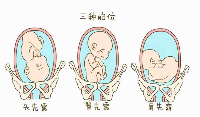 胎位不同的宝宝为了顺利生产需要进行内旋转