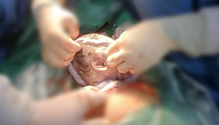 脐带绕颈是导致新生儿缺氧的一个原因