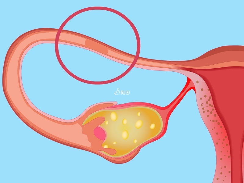 输卵管堵塞会导致不孕