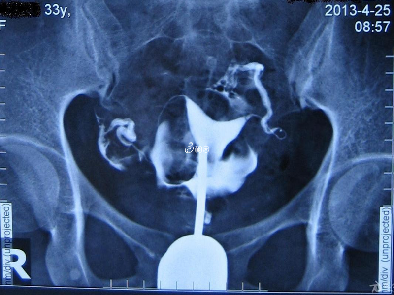 输卵管造影可能导致女性腹痛