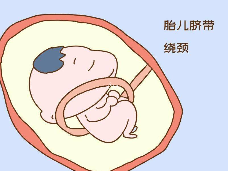 脐带过长会导致胎儿脐带绕颈