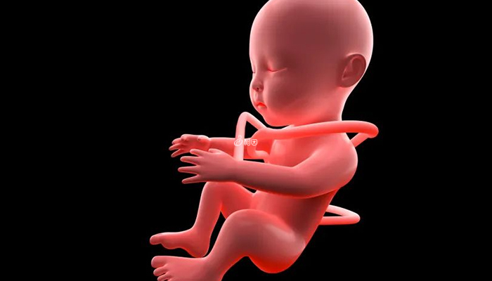 孕中晚期脐带绕颈可能导致无胎心