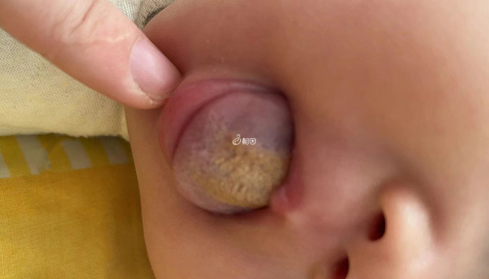 新生儿舌苔发黄可能是上火了