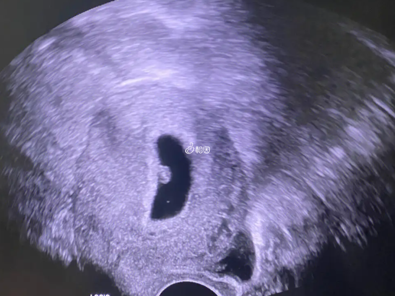 孕早期胚芽