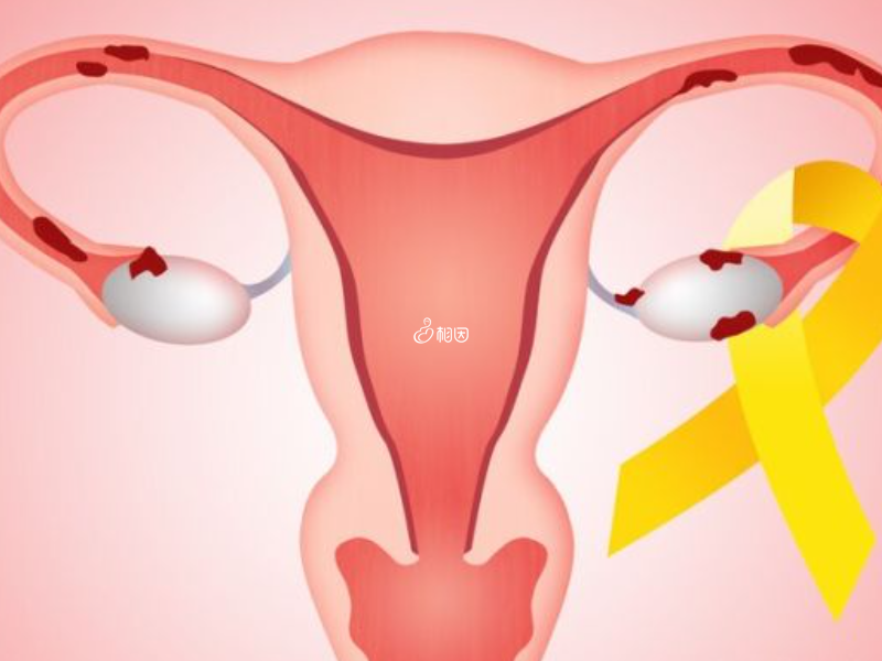 子宫内膜异位症可适当注射抑那通进行治疗