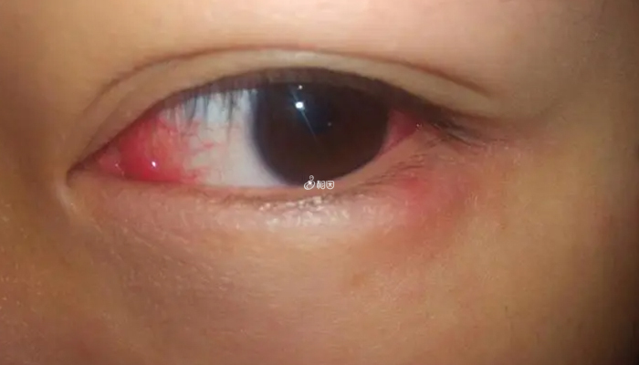 眼睛红可能是结膜炎