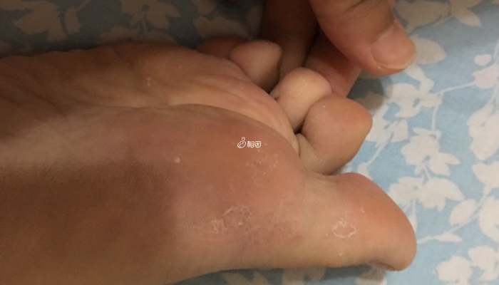 脚气由真菌感染引起