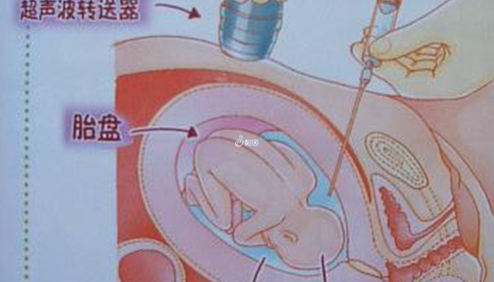 羊水穿刺检查用于诊断胎儿健康和发育情况