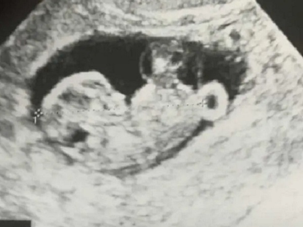 孕晚期胎动频繁