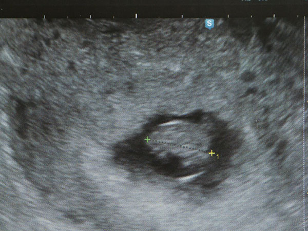 移植后3-7天是鲜胚着床时间段