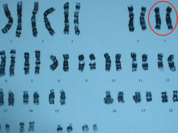 5号染色体异常会引起遗传病