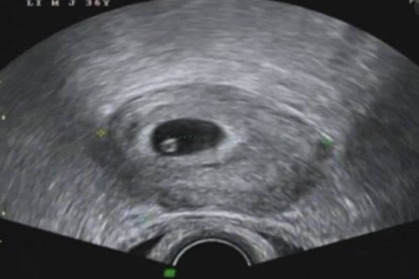 腹腔镜检查能准确排除宫外孕