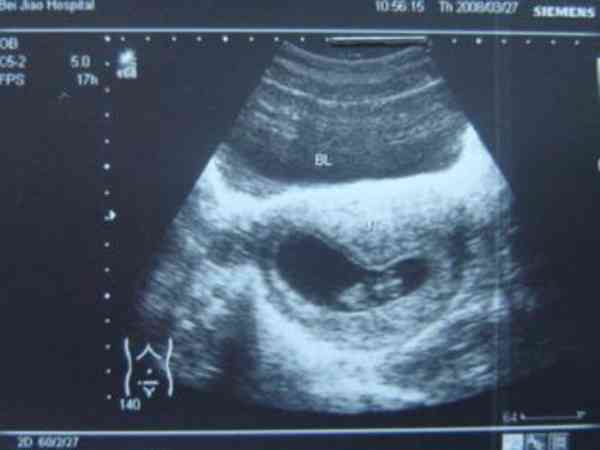 孕前检查能降低不良生育情况
