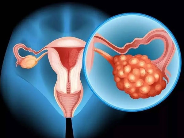 多囊卵巢会影响生育能力