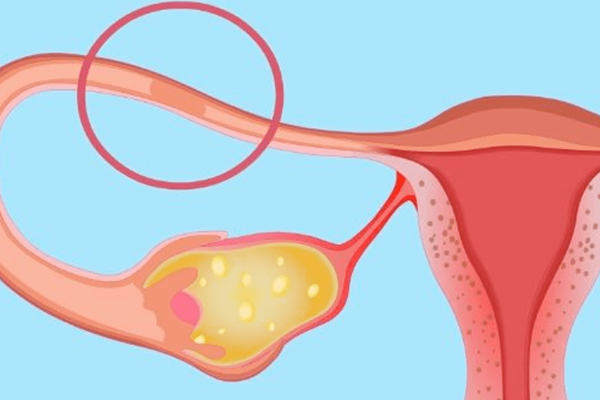 女性输卵管堵塞会有症状表现