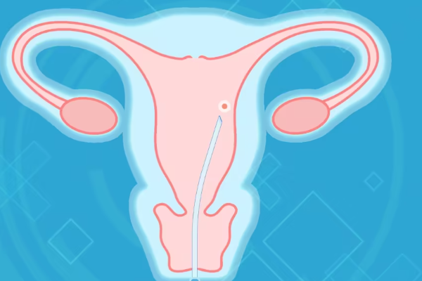 胚胎移植后不易频繁测孕