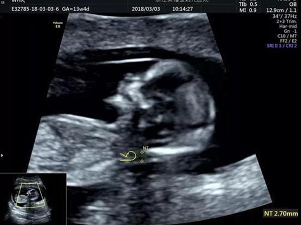 胎儿b超脊椎圆润是不是女宝宝