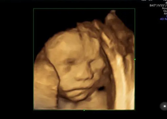 怀孕做四维显示男女怎么看