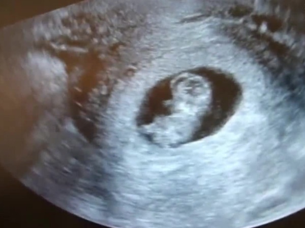 怀孕B超胎儿偏小生女孩