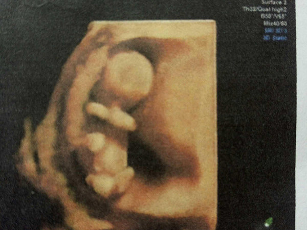 孕妇平躺可看胎儿性别