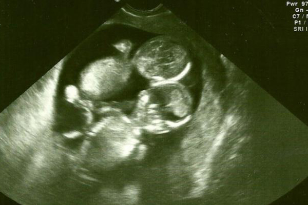 怀孕期间宝宝爱动属于正常现象