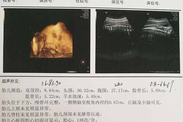 孕34周胎儿股骨长在6.0cm以上